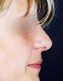 Miami Rhinoplasty